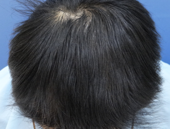 薄毛治療 発毛症例 32歳/MO型/7ヶ月後