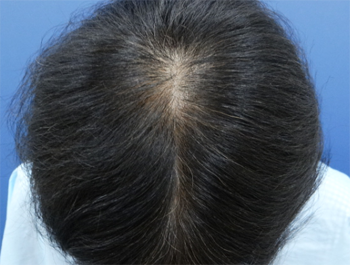 AGA治療例:60歳/頭頂部/薄毛歴12年/ｱﾙﾊﾞｲﾄ/8ヶ月後
