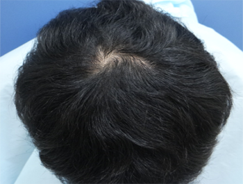 薄毛治療 発毛症例 27歳/O型/7ヶ月後
