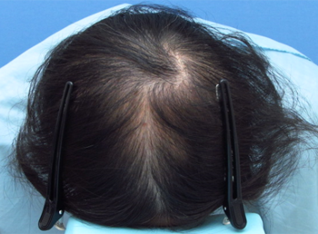 薄毛治療 発毛症例 49歳/頭頂部/初診時