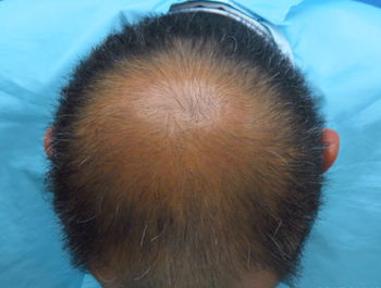 薄毛治療 発毛症例 44歳/MO型/初診時