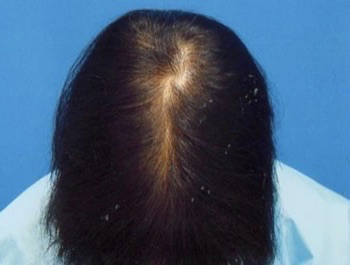 AGA治療例:45歳/頭頂部/薄毛歴10年/主婦/7ヶ月後