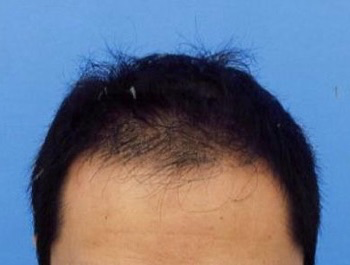薄毛治療 発毛症例 36歳/MO型/5ヶ月後