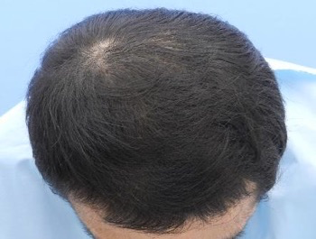 薄毛治療 発毛症例 26歳/MO型/6ヶ月後