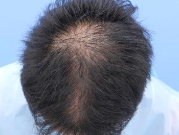 薄毛治療 発毛症例 25歳/O型/初診時