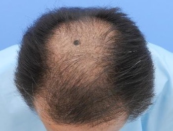 薄毛治療 発毛症例 54歳/MO型/初診時