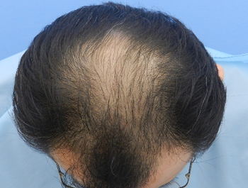 薄毛治療 発毛症例 50歳/O型/初診時