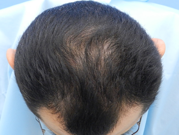 薄毛治療 発毛症例 50歳/O型/9ヶ月後