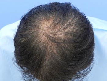 薄毛治療 発毛症例 50歳/O型/初診時