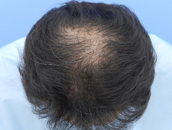 薄毛治療 発毛症例 49歳/O型/初診時