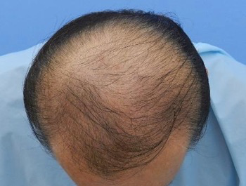 薄毛治療 発毛症例 61歳/MO型/初診時
