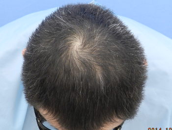 薄毛治療 発毛症例 41歳/MO型/10ヶ月後