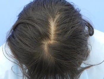 薄毛治療 発毛症例 23歳/頭頂部/6ヶ月後