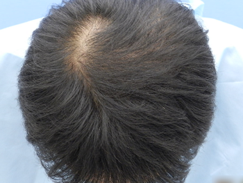 薄毛治療 発毛症例 39歳/O型/11ヶ月後