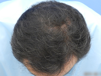 薄毛治療 発毛症例 45歳/MO型/8ヶ月後