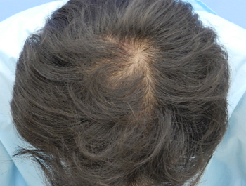 薄毛治療 発毛症例 40歳/MO型/9ヶ月後