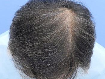 薄毛治療 発毛症例 55歳/O型/9ヶ月後