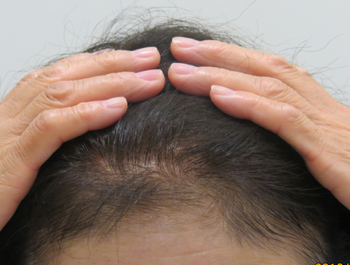薄毛治療 発毛症例 64歳/前頭部/8ヶ月後