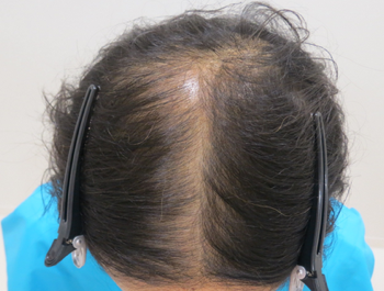 AGA治療例:57歳/頭頂部/薄毛歴2年//初診時