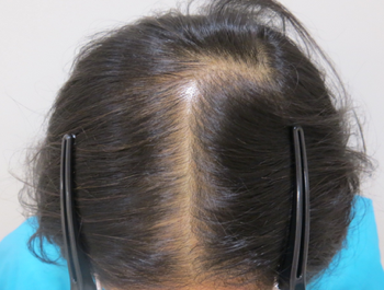 AGA治療例:57歳/頭頂部/薄毛歴2年//9ヶ月後