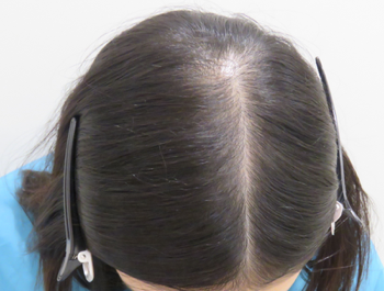薄毛治療 発毛症例 20歳/頭頂部/8ヶ月後