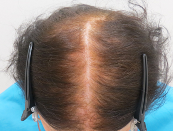 AGA治療例:77歳/頭頂部/薄毛歴1年//初診時