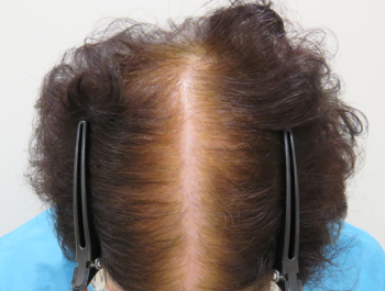 AGA治療例:77歳/頭頂部/薄毛歴1年//6ヶ月後