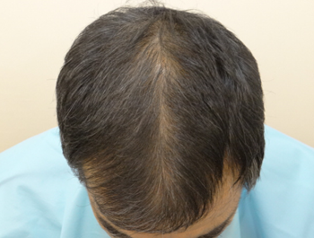 薄毛治療 発毛症例 55歳/MO型/6ヶ月後