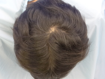 薄毛治療 発毛症例 45歳/O型/7ヶ月後