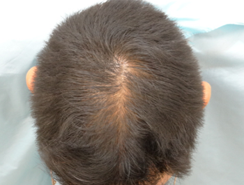 薄毛治療 発毛症例 40歳/O型/初診時
