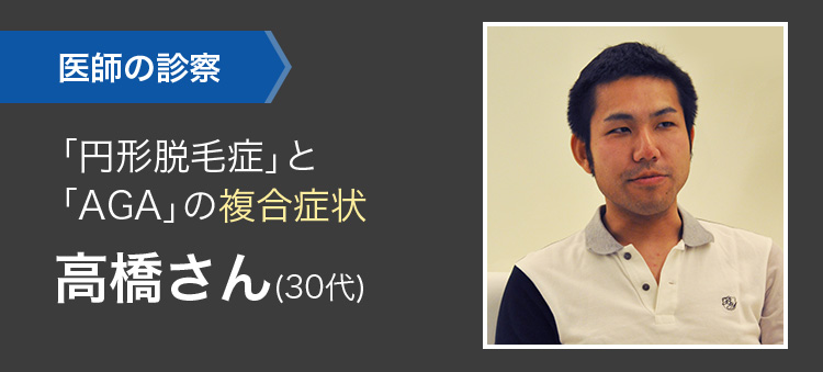 ｢円形脱毛症｣と｢AGA｣の複合症状  高橋さん(30代)