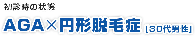 初診時の状態 AGA×円形脱毛症 (30代男性)