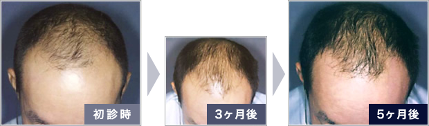 AGA治療症例 VI型 29歳 男性の写真