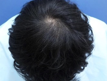 薄毛治療 発毛症例 29歳/O型/6ヶ月後