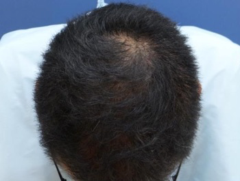 薄毛治療 発毛症例 37歳/MO型/5ヶ月後