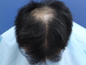 薄毛治療 発毛症例 29歳/O型/初診時
