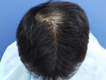 薄毛治療 発毛症例 29歳/O型/5ヶ月後