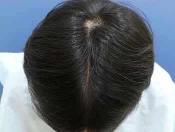薄毛治療 発毛症例 22歳/MO型/4ヶ月後