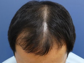 薄毛治療 発毛症例 37歳/M型/初診時