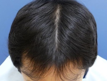 薄毛治療 発毛症例 37歳/M型/5ヶ月後