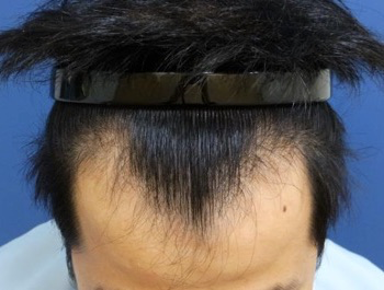 薄毛治療 発毛症例 22歳/M型/初診時