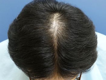 薄毛治療 発毛症例 50歳/MO型/5ヶ月後