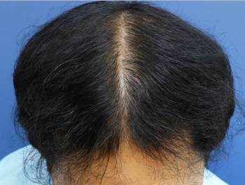 薄毛治療 発毛症例 42歳/MO型/10ヶ月後