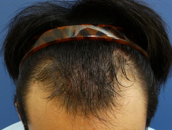 薄毛治療 発毛症例 29歳/M型/初診時