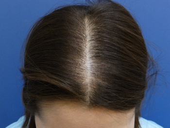 AGA治療例:33歳/頭頂部/薄毛歴8年//2ヶ月後