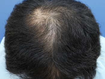 薄毛治療 発毛症例 51歳/O型/8ヶ月後