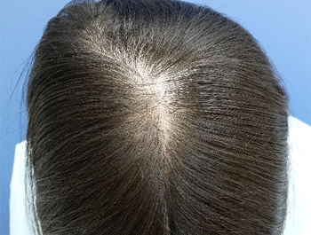 薄毛治療 発毛症例 38歳/頭頂部/初診時
