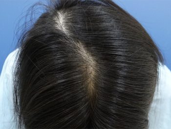 薄毛治療 発毛症例 38歳/頭頂部/6ヶ月後