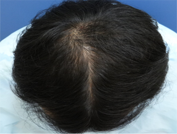 薄毛治療 発毛症例 34歳/O型/9ヶ月後