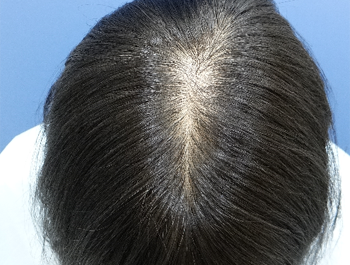 薄毛治療 発毛症例 41歳/O型/初診時